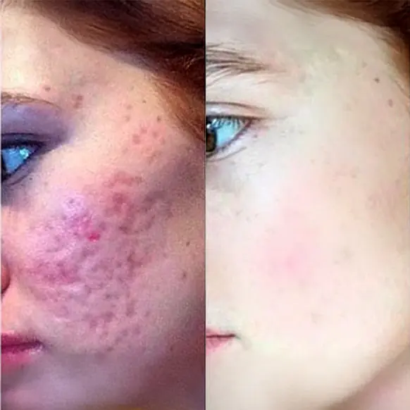 Vorher Nachher CO2 Laser Pigmentflecken Essen