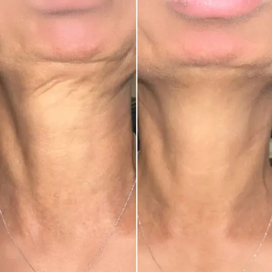 Vorher Nachher RF- und Microneedling Hautverjüngung feine Fältchen Essen